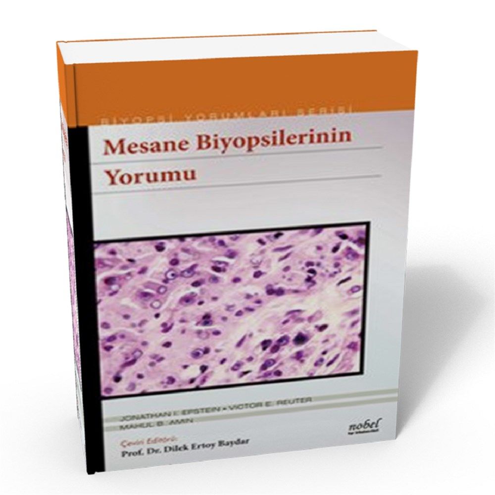 Mesane Biyopsilerinin Yorumu - Biyopsi Yorumları Serisi